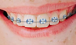 lightforce braces